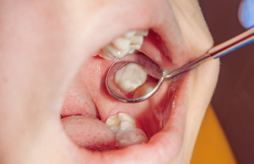 Restauração Dental